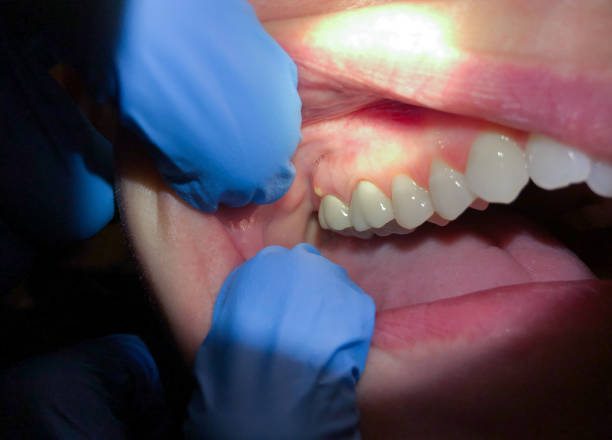 Best Emergency Gum Treatment in Arlington, OH